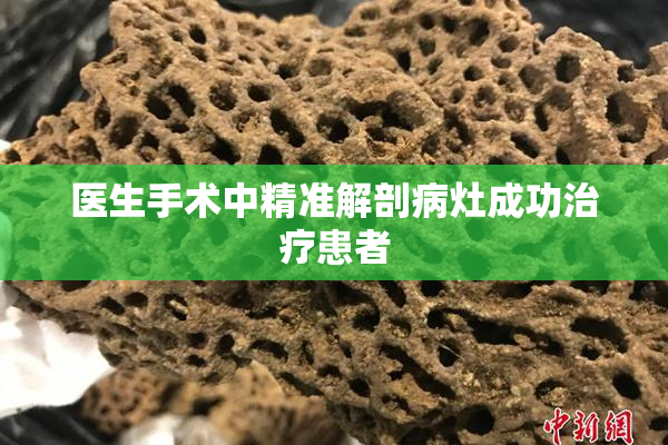 医生手术中精准解剖病灶成功治疗患者